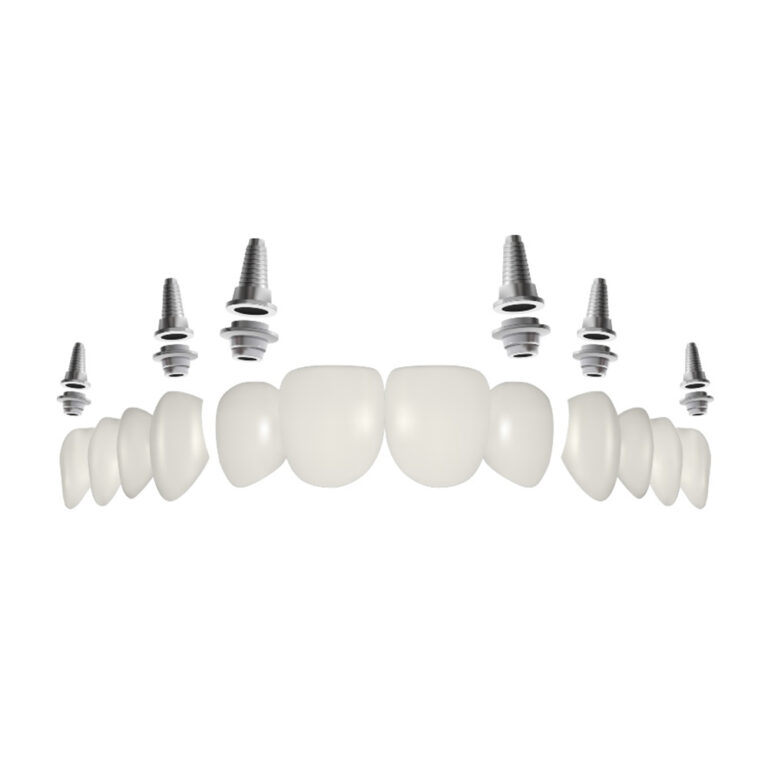 3 On 6 Dental Implants