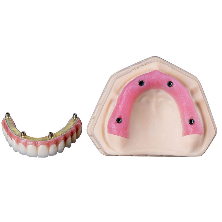 4 On 4 Dental Implants