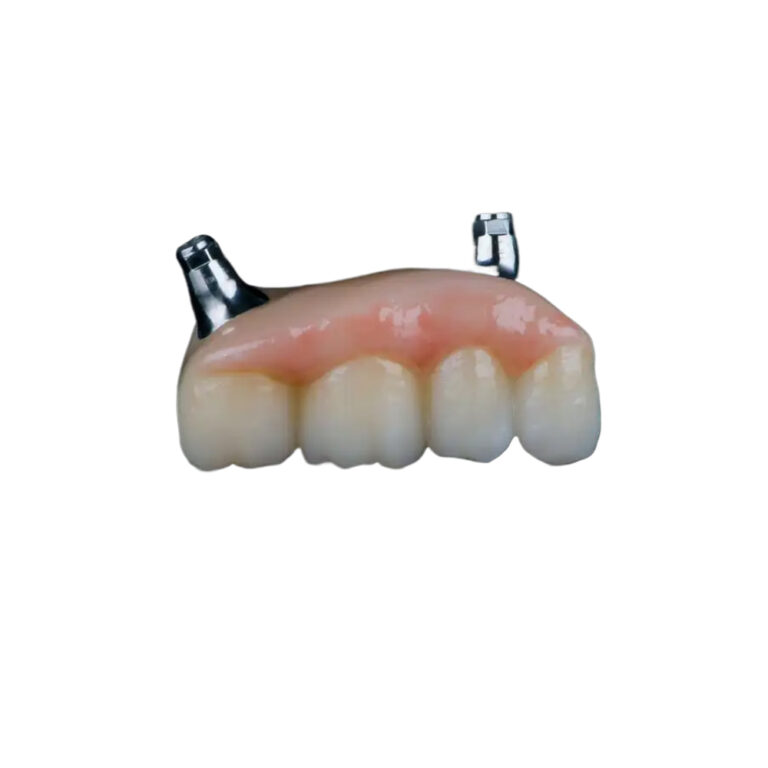 4 Teeth On 2 Implants