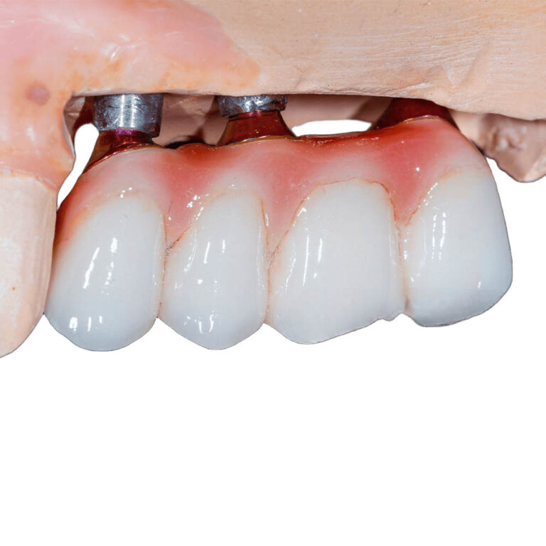 4 Teeth On 2 Implants