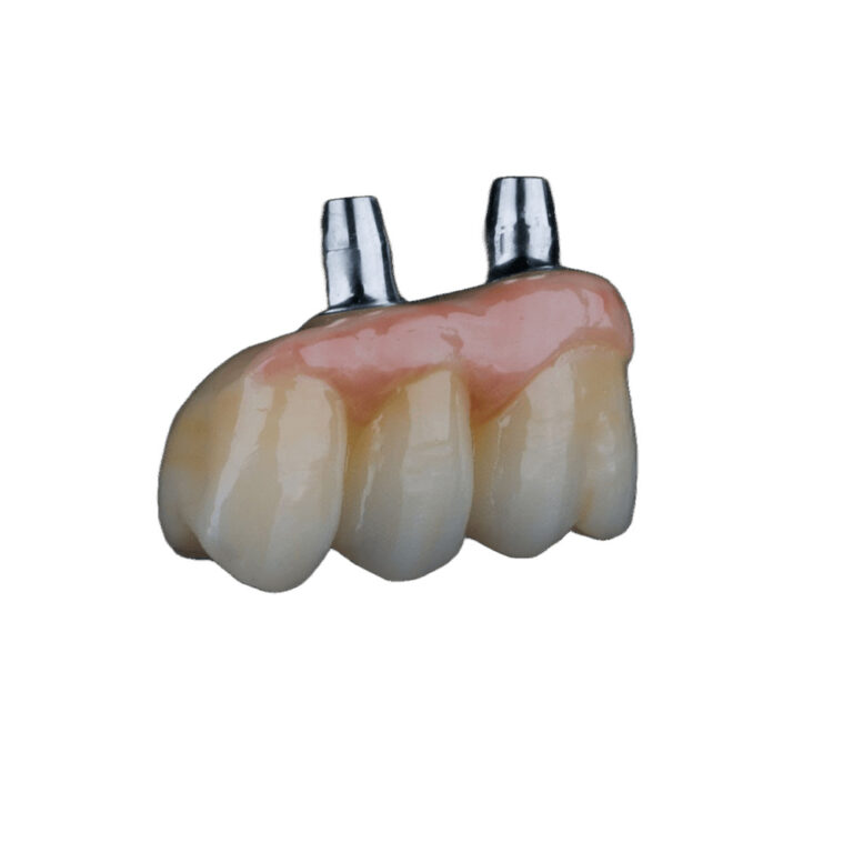 4 Teeth On 2 Implants