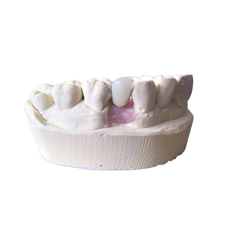 A1 Zirconia Crowns