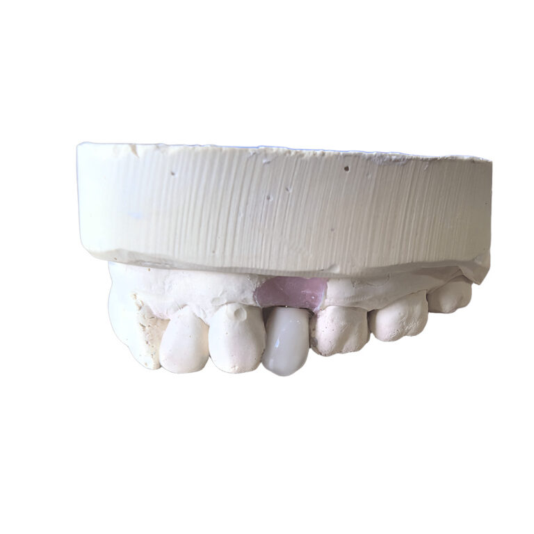 A1 Zirconia Crowns