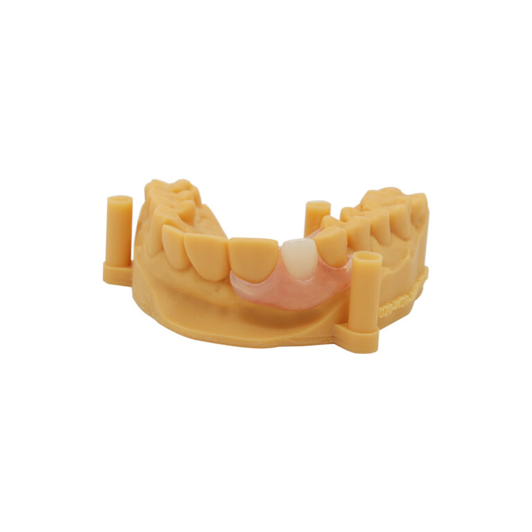 Adding Teeth to Valplast Partials Denture
