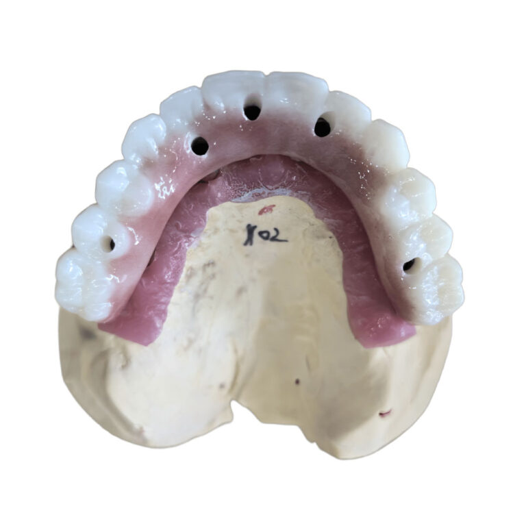 All On 5 Dental Implants