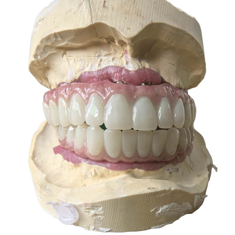 All On 5 Dental Implants