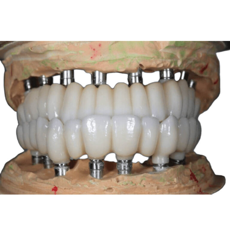 All On 8 Zirconia Implants