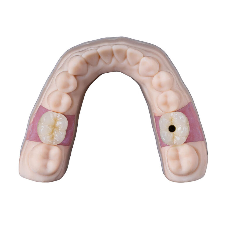 Cement Retained Implant Crown