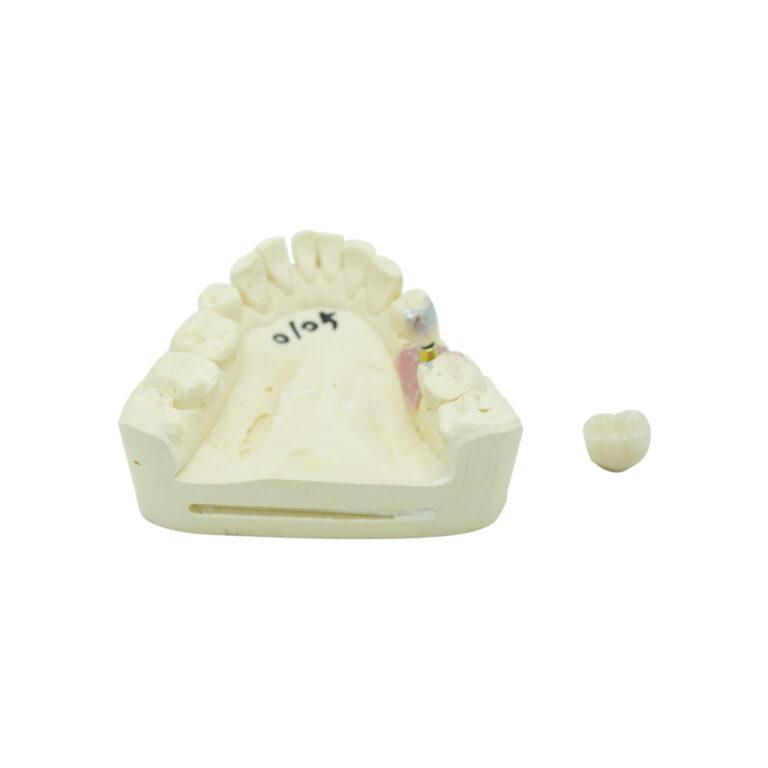 Cement Retained Implant Crown