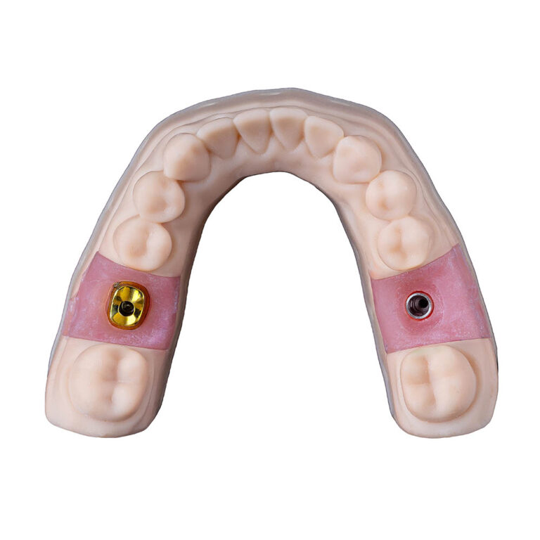 Cement Retained Implant Crown