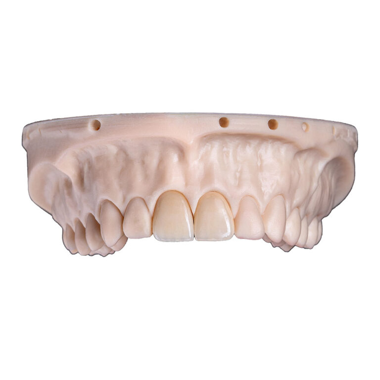 Ceramic Veneers