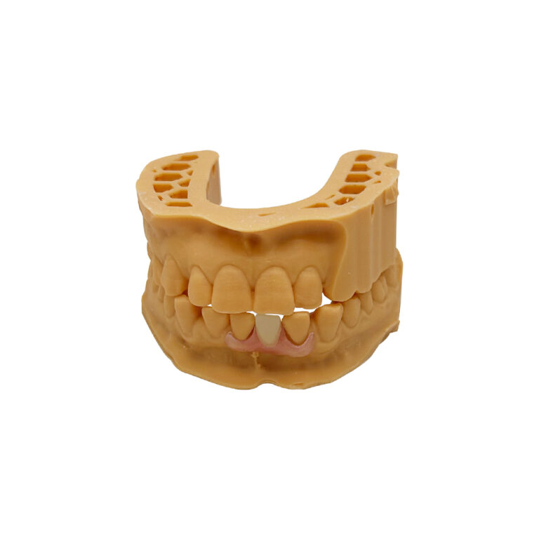 Clasps for Partial Dentures
