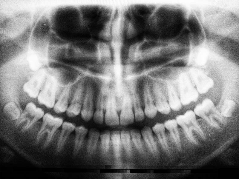 Dental Bones
