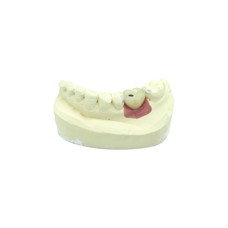 Dental Implant For One Tooth