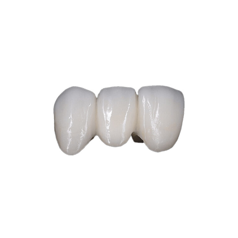Emax Crowns Front Teeth