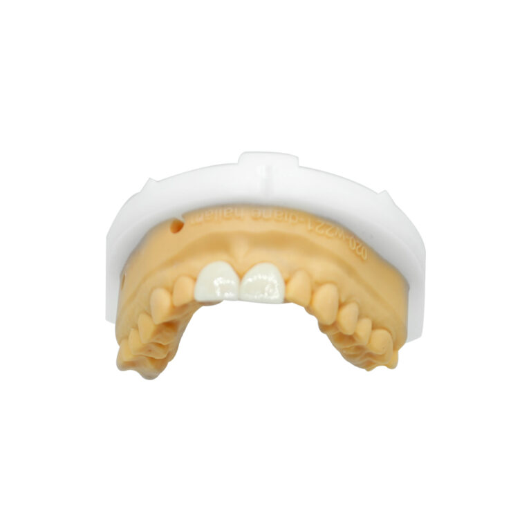 Front Anterior Teeth Veneers