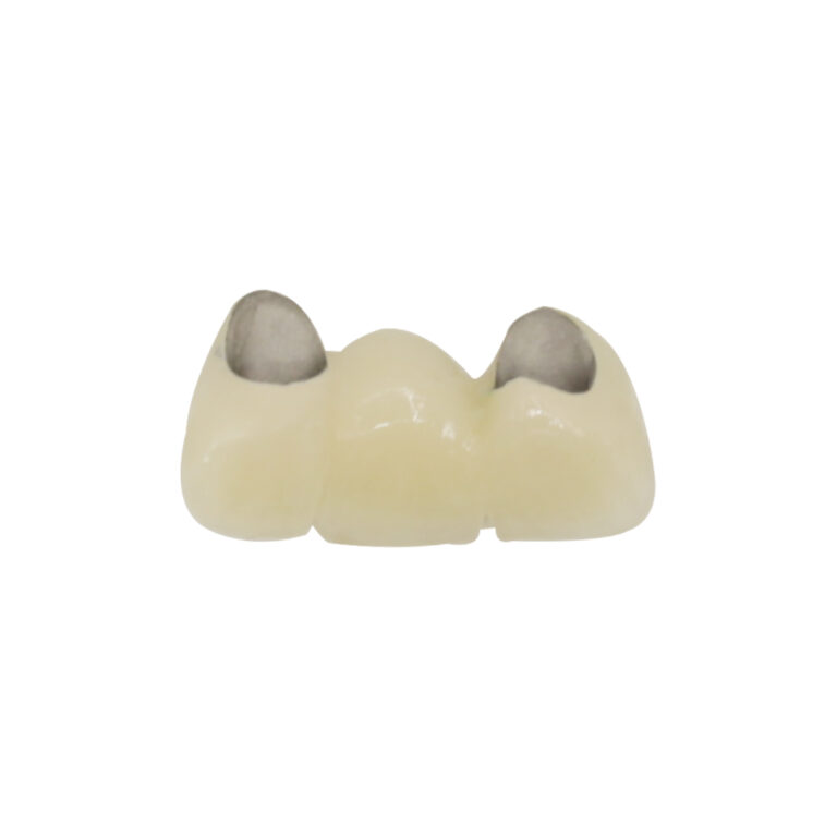 Front Tooth Porcelain Fused to Metal Crown