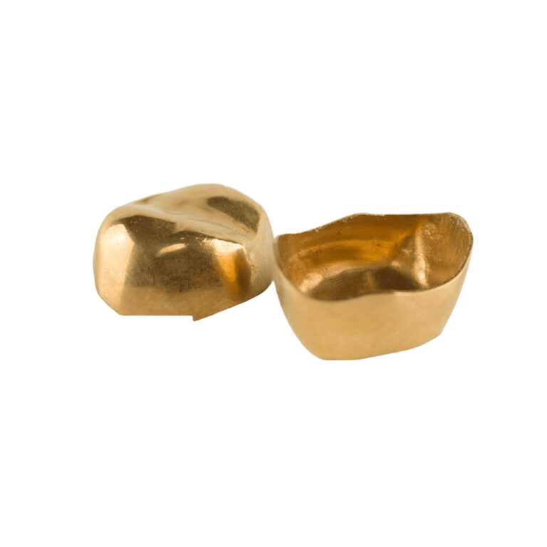 Gold Inlays And Onlays