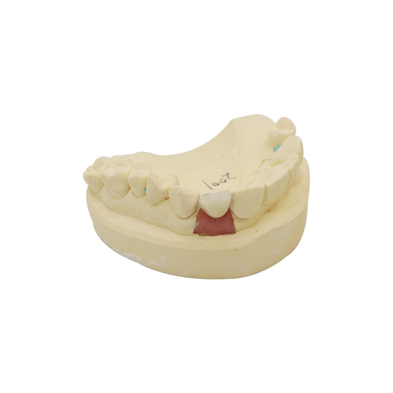 Lateral Incisor Implant