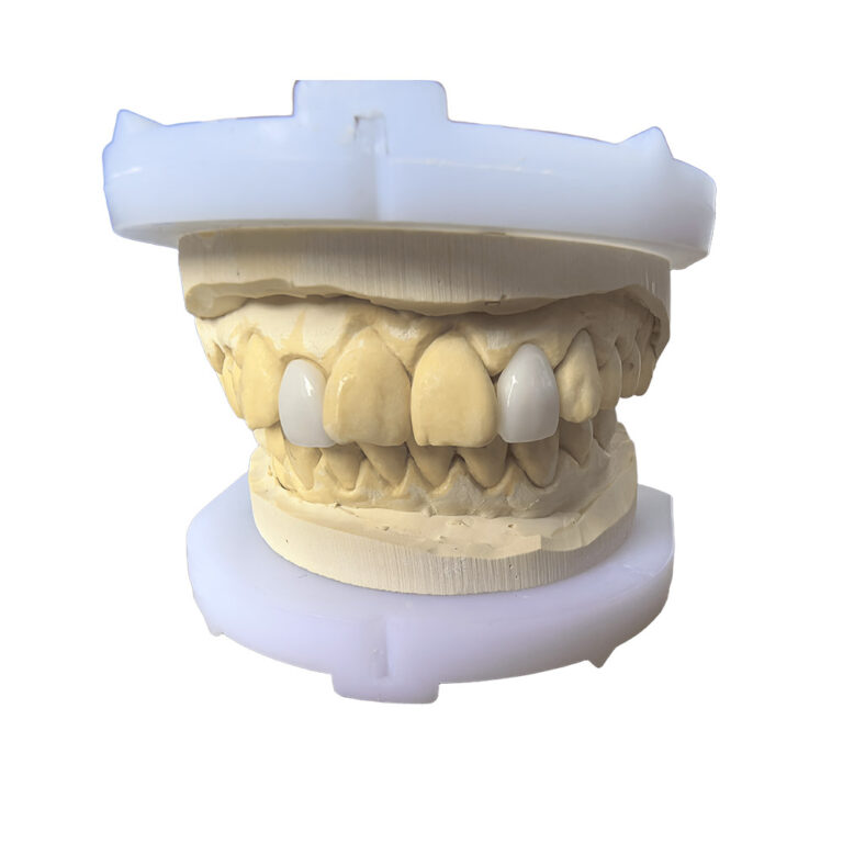 Lateral Incisor Veneer