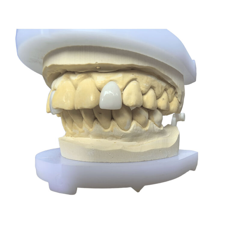 Lateral Incisor Veneer