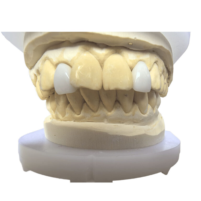 Lateral Incisor Veneer