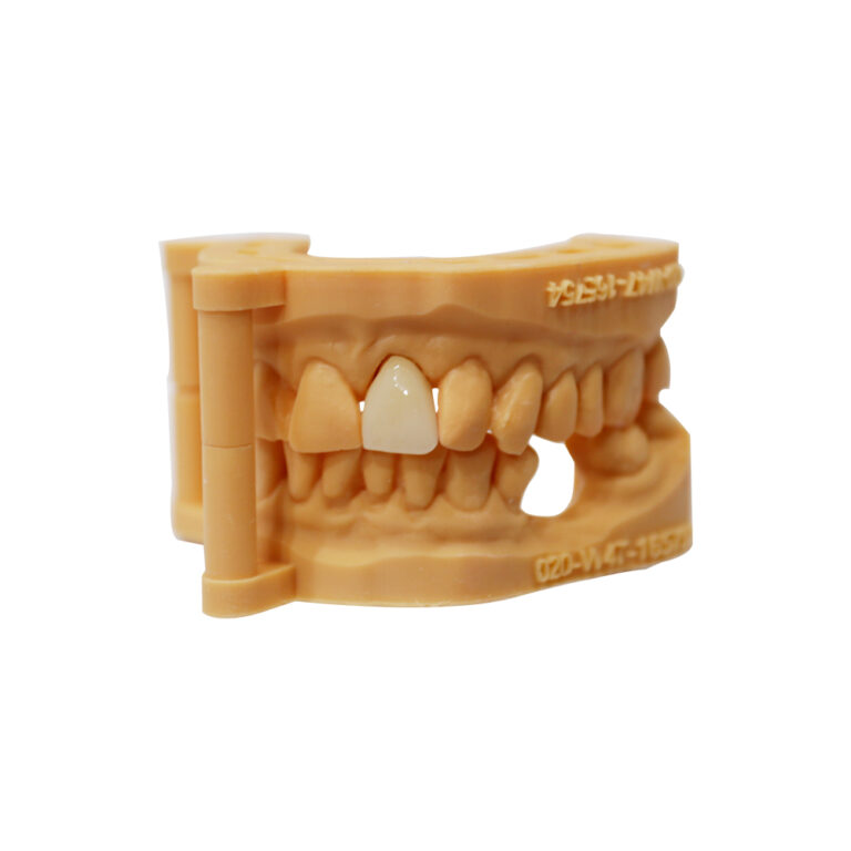 Layered Zirconia Crown