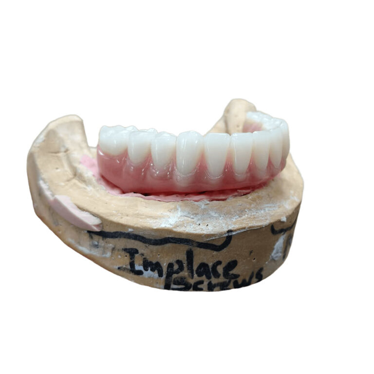 Lower Denture Implants