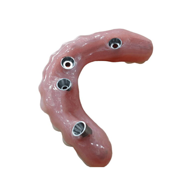 Lower Denture Implants