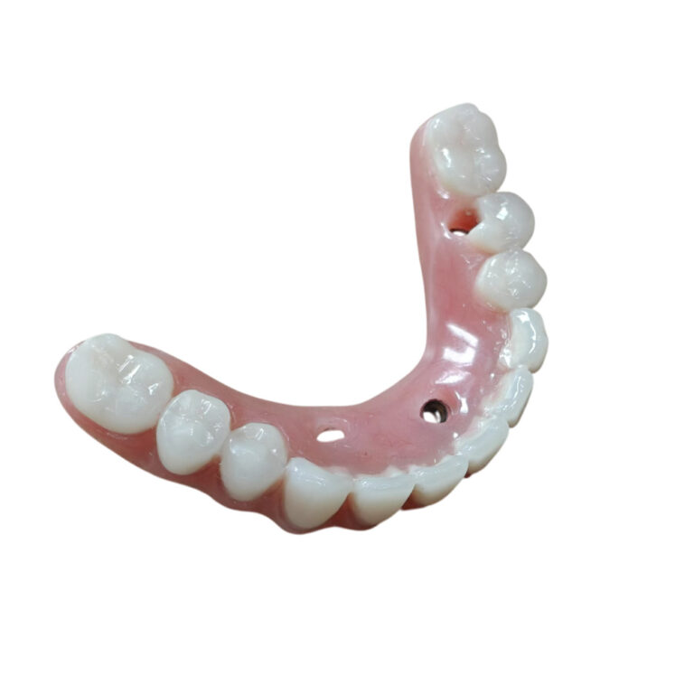 Lower Denture Implants