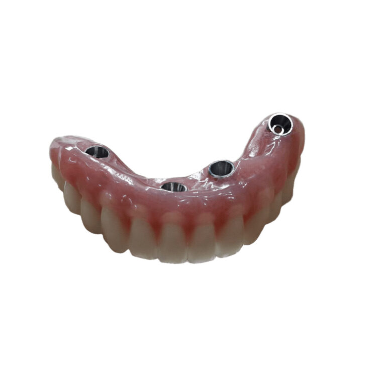 Lower Denture Implants