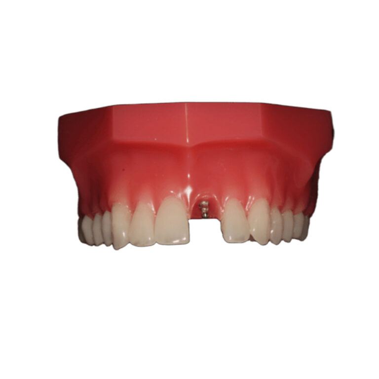 Mini Dental Implants