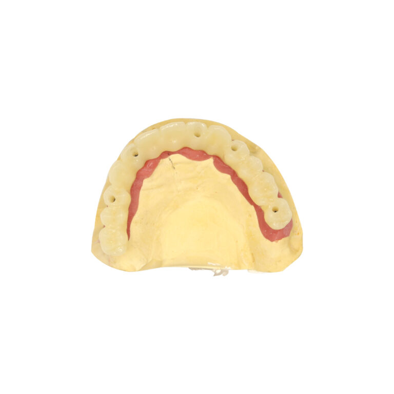 Multiple Dental Implants