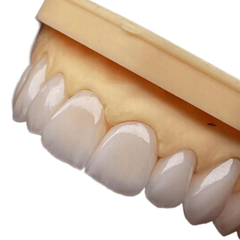 Natural White Teeth Veneers