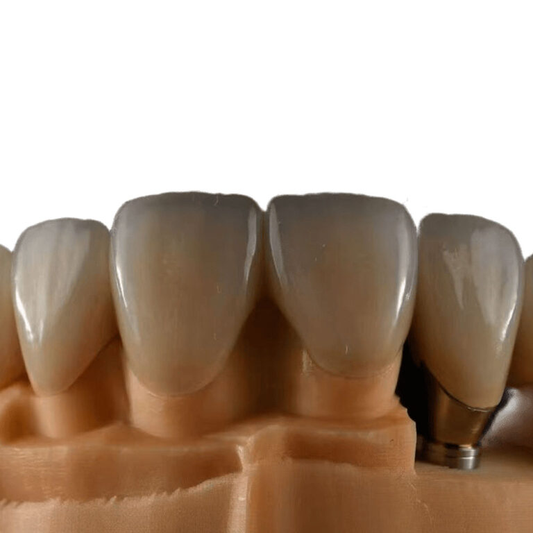 Natural White Teeth Veneers