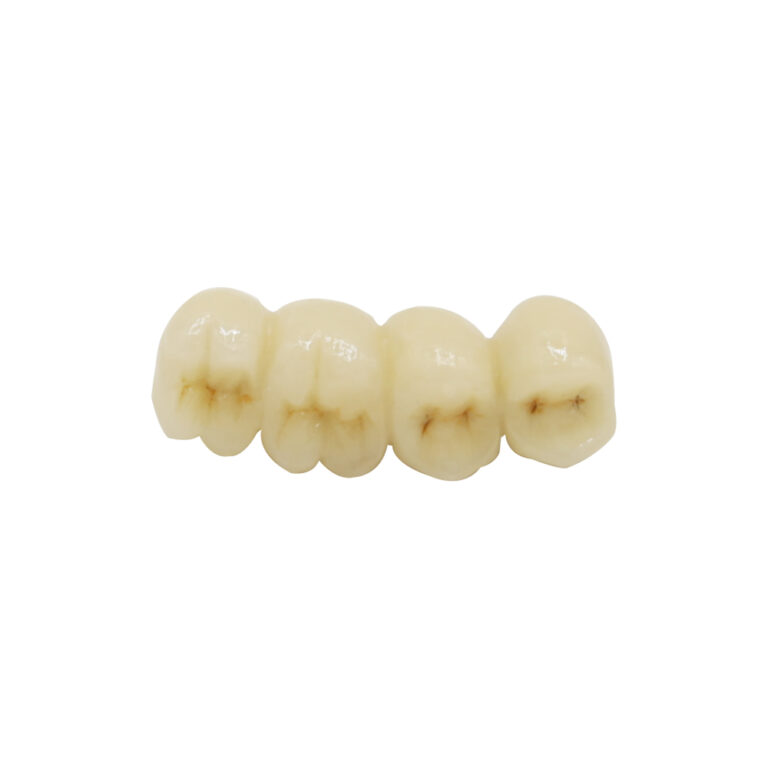 PFM Cantilever Bridge