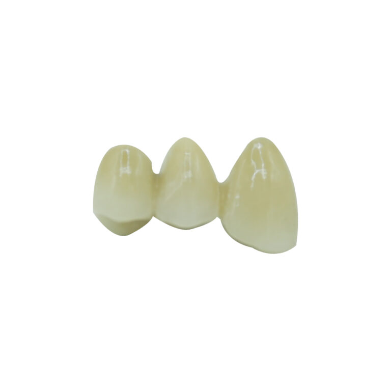 PFM Cantilever Bridge