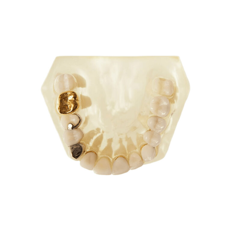 PFM Crown with Metal Lingual