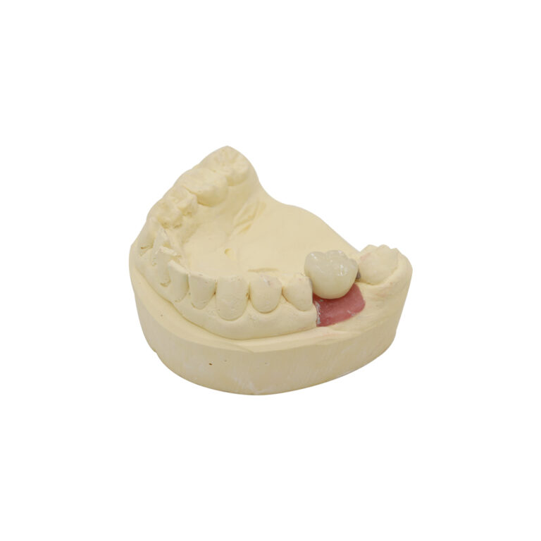 PFM Implant Crown