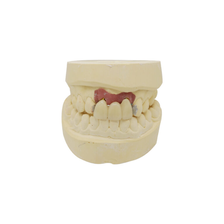 Partial Dental Implants