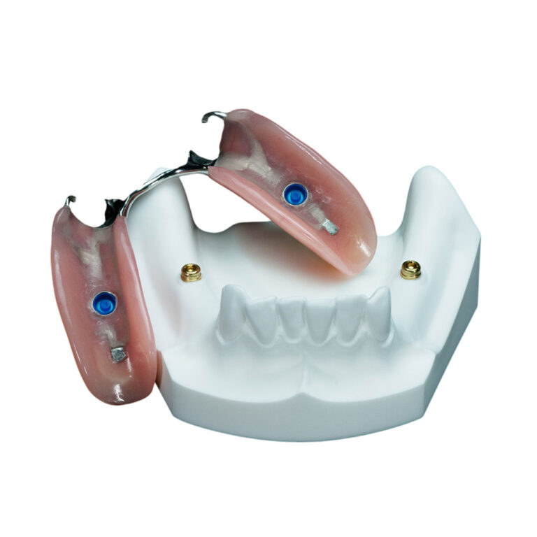 Partial Implant Dentures