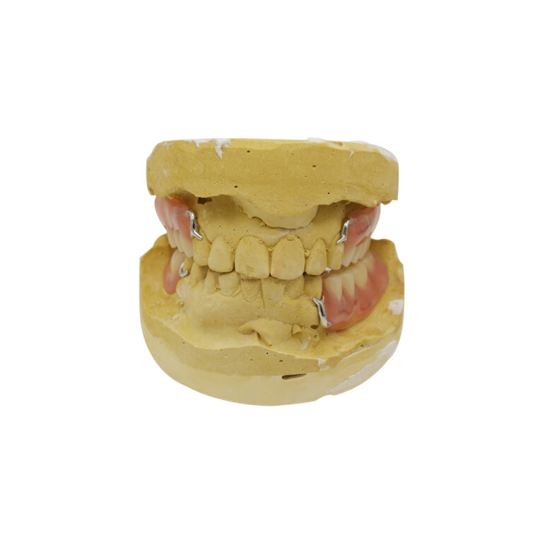 Partial Metal Dentures with Clasps