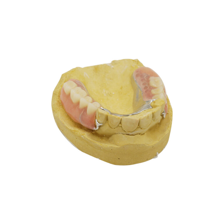Partial Metal Dentures with Clasps