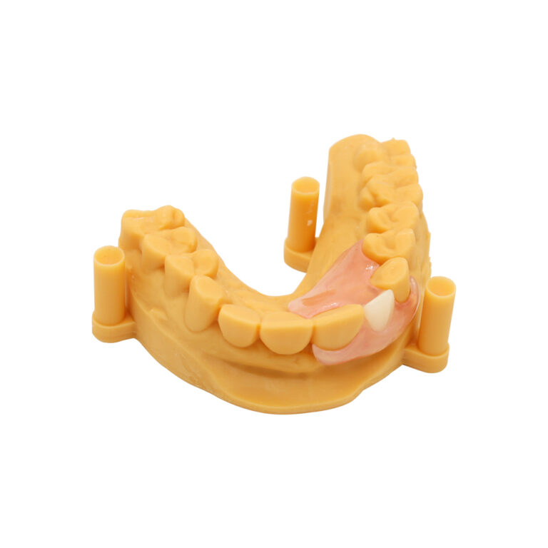 Removable Single Tooth Denture