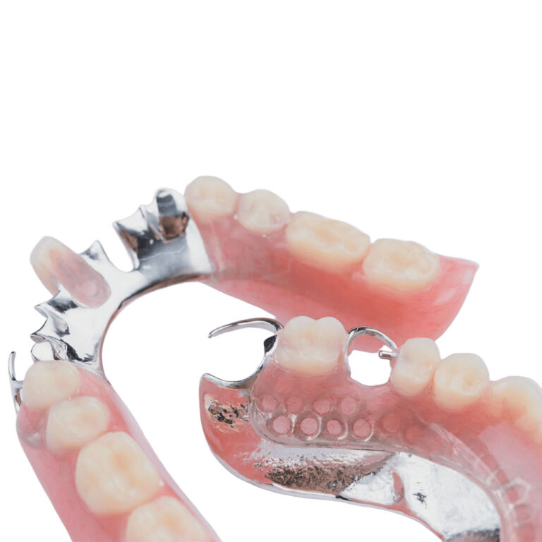 Titanium Partial Denture Plates