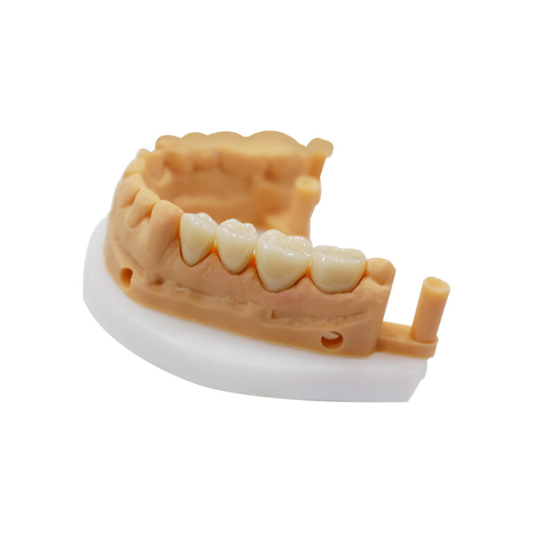 Translucent Zirconia Crowns