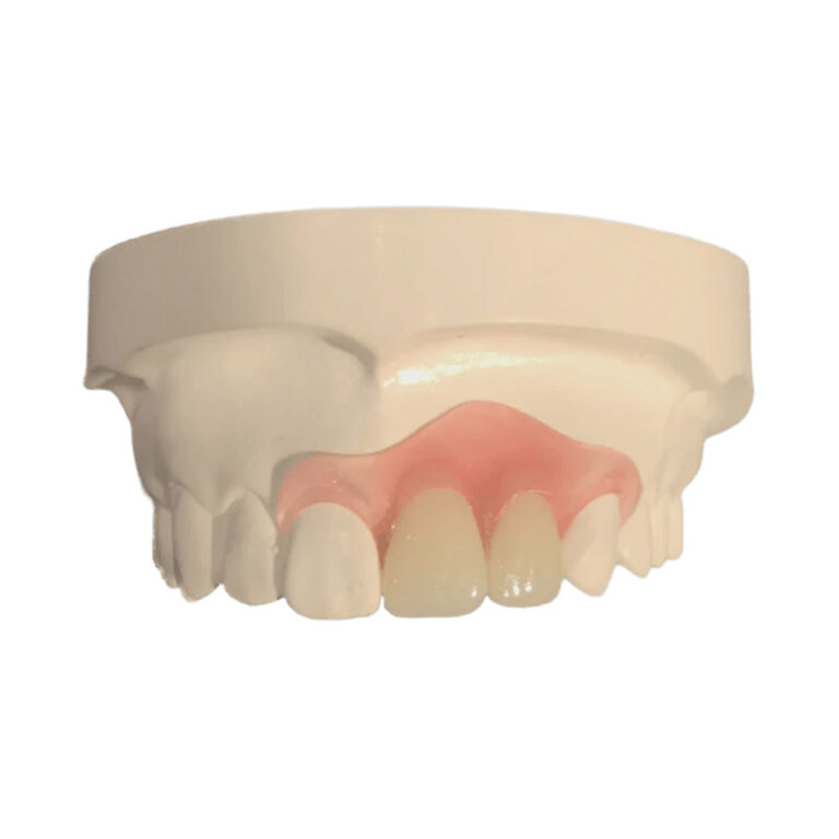 Two Front Teeth Partial Dentures