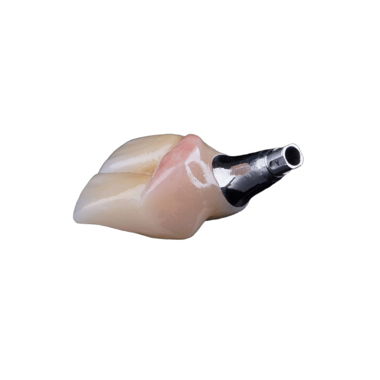 Two Teeth On One Implant