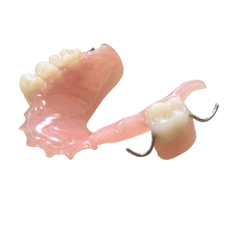 Unilateral Valplast Flexible Partial Denture