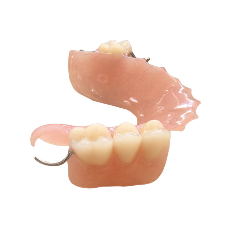 Unilateral Valplast Flexible Partial Denture